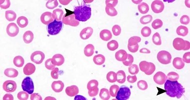 إدارة الأغذية والعقاقير توافق على عقار جديد لسرطان الدم الليمفاوي المزمن